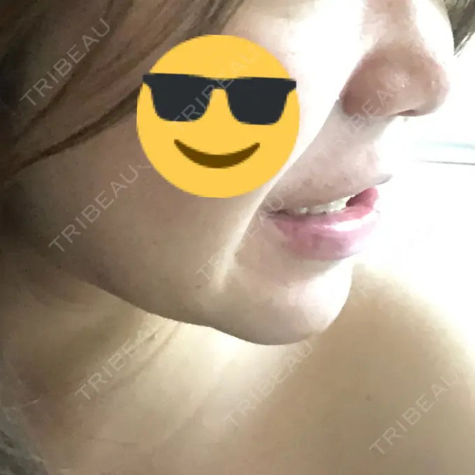 二重埋没 / 目頭切開 / ルフォー+ssro（両あご) / 輪郭修正 View美容整形外科 DAY 87 メイン用