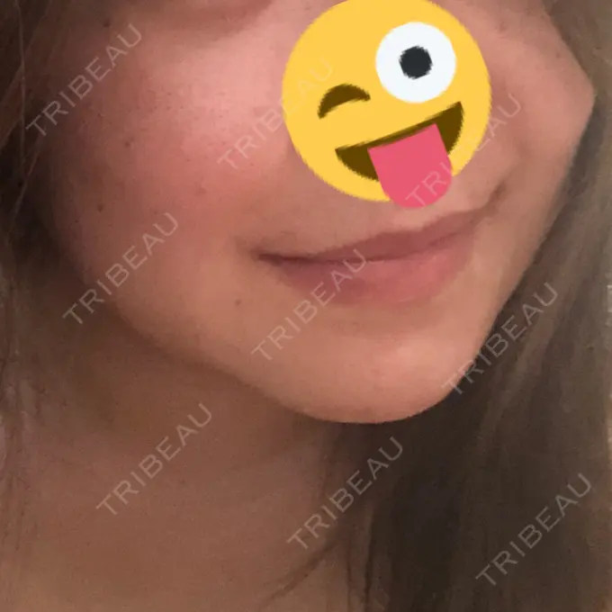 二重埋没 / 目頭切開 / ルフォー+ssro（両あご) / 輪郭修正 View美容整形外科 DAY 87 メイン用