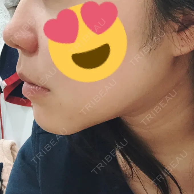 二重埋没 / 目頭切開 / ルフォー+ssro（両あご) / 輪郭修正 View美容整形外科 DAY 87 メイン用