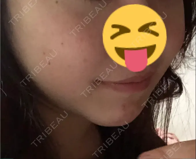 二重埋没 / 目頭切開 / ルフォー+ssro（両あご) / 輪郭修正 View美容整形外科 DAY 117 メイン用