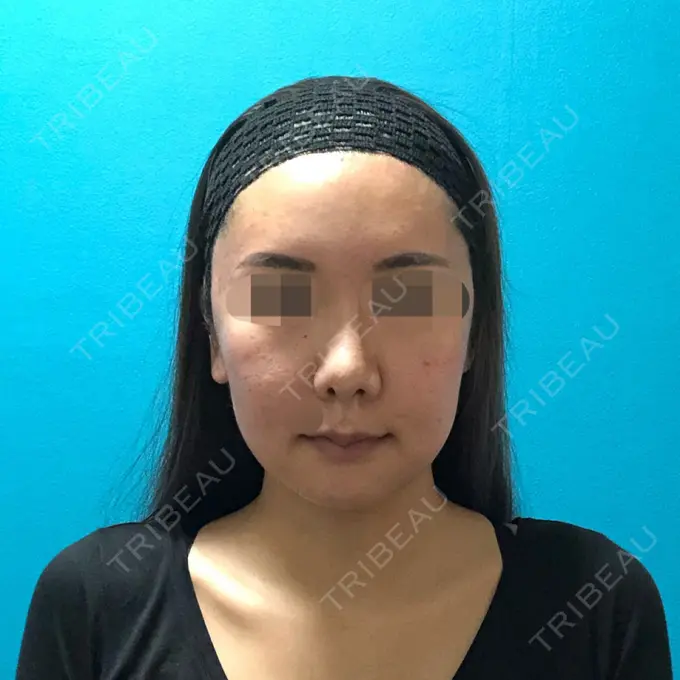 骨切り（あご） / 骨削り（頬） / ルフォー+ssro（両あご) / 輪郭修正 / 鼻翼基部形成（貴族手術） / その他（輪郭） エバーエム歯科 DAY 31 メイン用