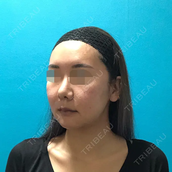 骨切り（あご） / 骨削り（頬） / ルフォー+ssro（両あご) / 輪郭修正 / 鼻翼基部形成（貴族手術） / その他（輪郭） エバーエム歯科 DAY 31 メイン用