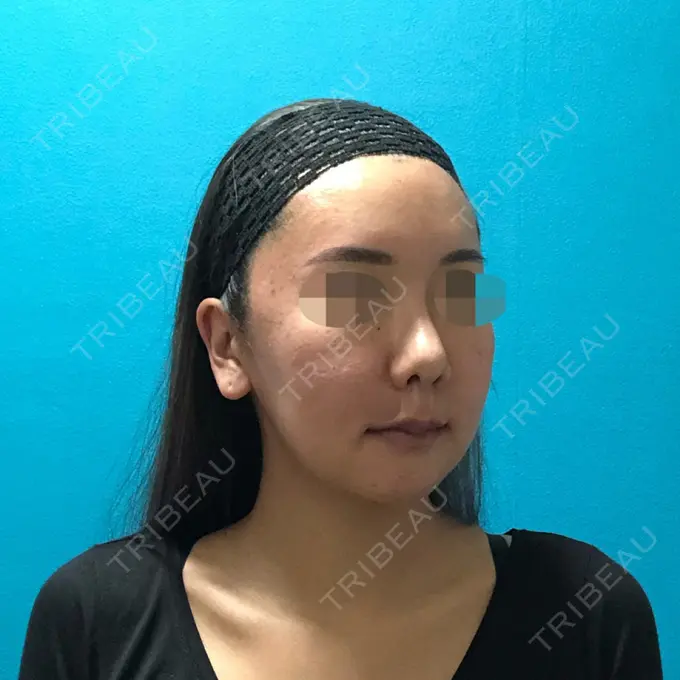 骨切り（あご） / 骨削り（頬） / ルフォー+ssro（両あご) / 輪郭修正 / 鼻翼基部形成（貴族手術） / その他（輪郭） エバーエム歯科 DAY 31 メイン用