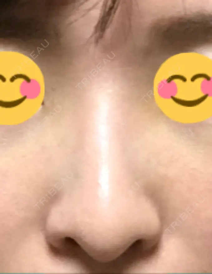 ヒアルロン酸注入（鼻） BIANCA銀座 DAY 5 メイン用