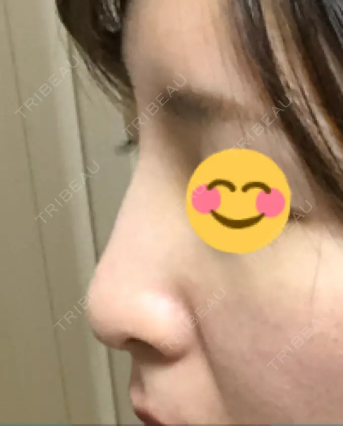 ヒアルロン酸注入（鼻） BIANCA銀座 DAY 5 メイン用