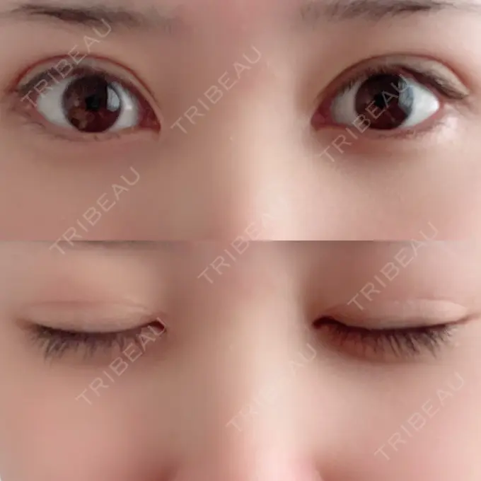 二重切開 / 目頭切開 城本クリニック 豊橋院 AFTER メイン用