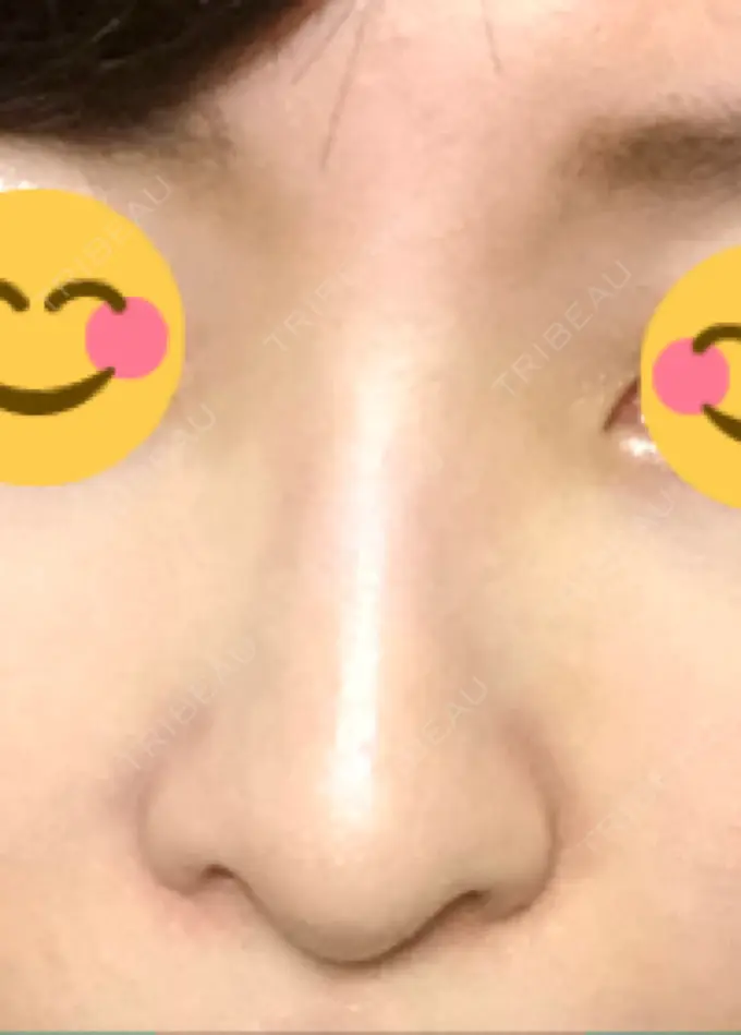 ヒアルロン酸注入（鼻） BIANCA銀座 AFTER メイン用