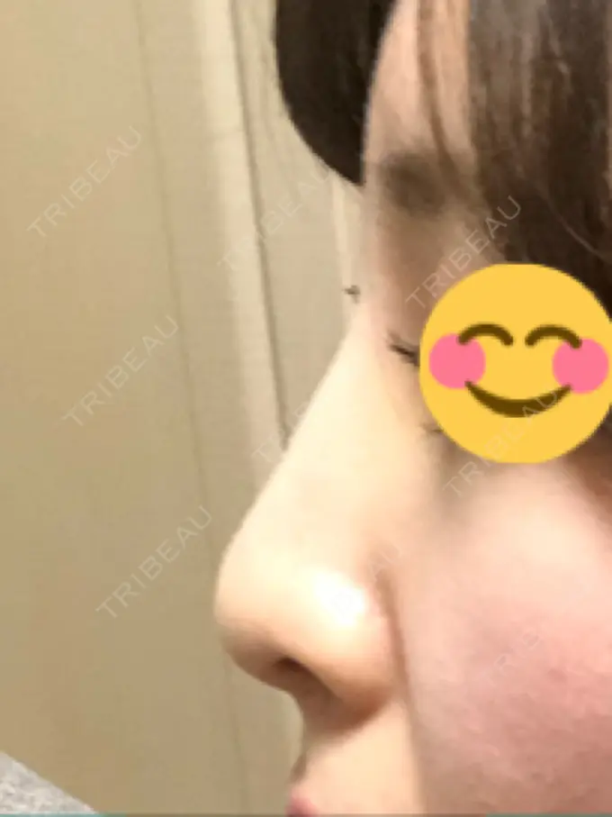 ヒアルロン酸注入（鼻） BIANCA銀座 DAY 6 メイン用