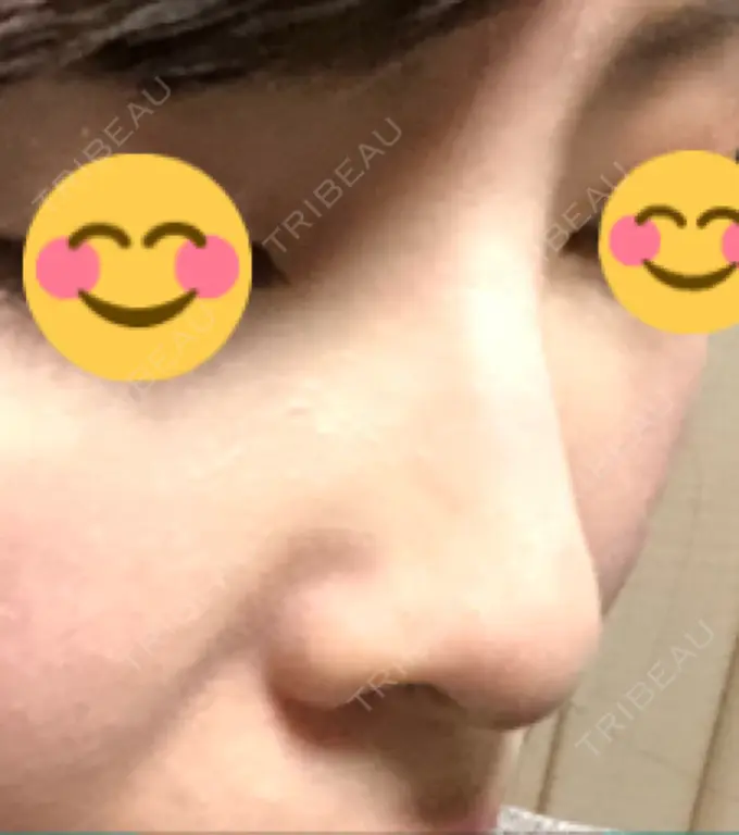 ヒアルロン酸注入（鼻） BIANCA銀座 DAY 6 メイン用