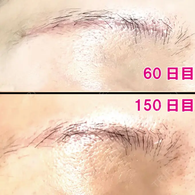 眉下切開 エイペックス美容外科 DAY 150 メイン用