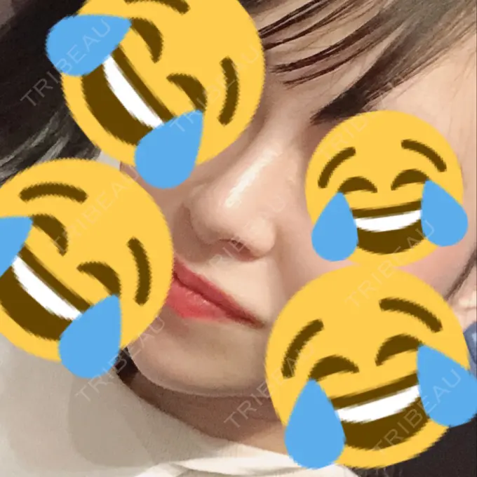 鼻尖形成（切開） / 小鼻縮小（切開） / 軟骨移植 / 骨切幅寄せ / ワシ鼻修正・ハンプ切除 FROM B整形外科 (旧バウム整形外科) DAY 56 メイン用