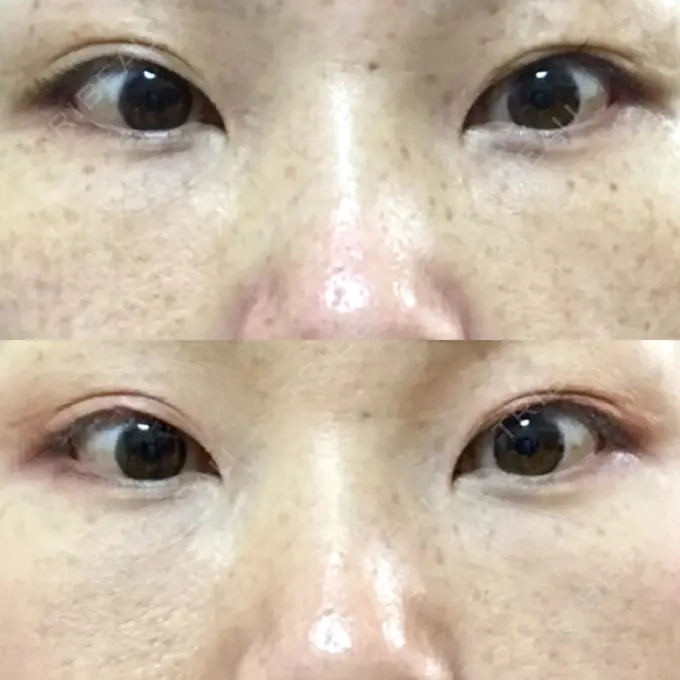 下まぶたたるみ取り / 下まぶたの脂肪取り 韓国ST美容整形外科 DAY 126 メイン用