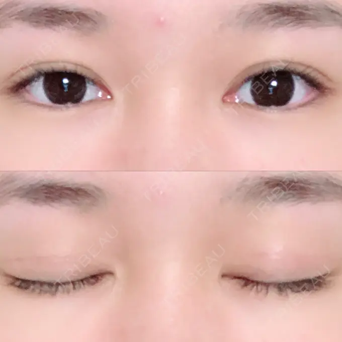 二重切開 / 上まぶたの脂肪取り / その他（目元） 湘南美容クリニック 新宿本院 DAY 90 メイン用