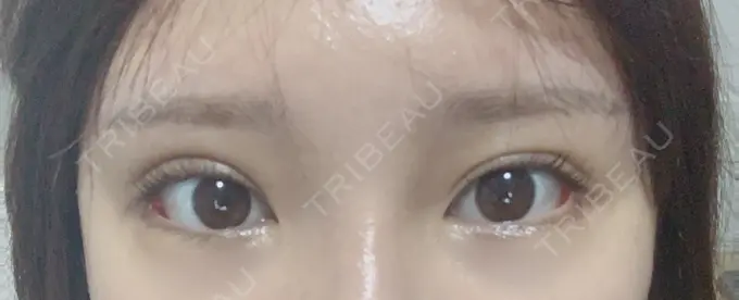 目尻切開 / 目元修正 / 目尻靭帯移動 DIVINE（ディバイン）整形外科 DAY 18 メイン用