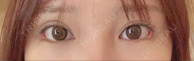 目尻切開 / 目元修正 / 目尻靭帯移動 DIVINE（ディバイン）整形外科 DAY 31 メイン用