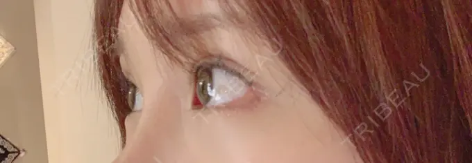 目尻切開 / 目元修正 / 目尻靭帯移動 DIVINE（ディバイン）整形外科 DAY 31 メイン用