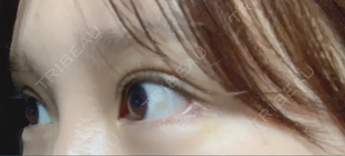 目尻切開 / 目元修正 / 目尻靭帯移動 DIVINE（ディバイン）整形外科 DAY 38 メイン用