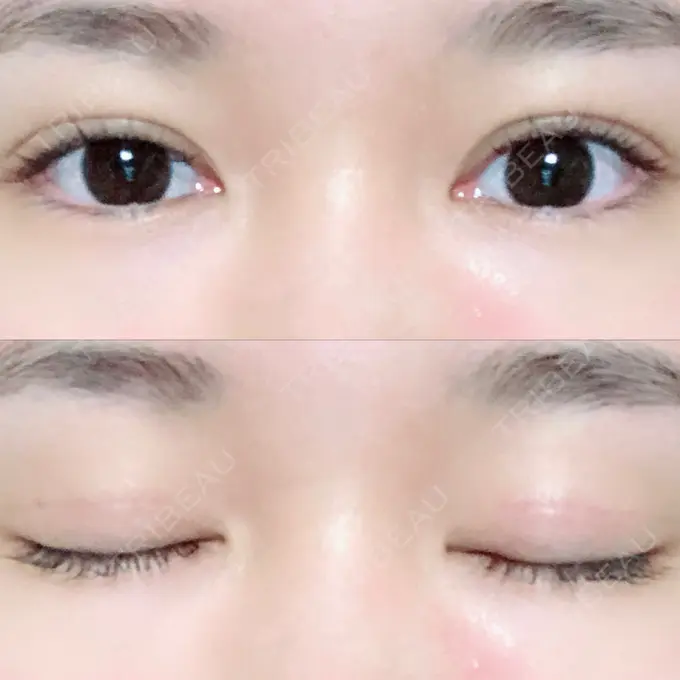 二重切開 / 上まぶたの脂肪取り / その他（目元） 湘南美容クリニック 新宿本院 DAY 93 メイン用