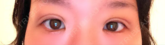 二重埋没 湘南美容クリニック 京都院 DAY 8 メイン用