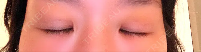 二重埋没 湘南美容クリニック 京都院 DAY 8 メイン用