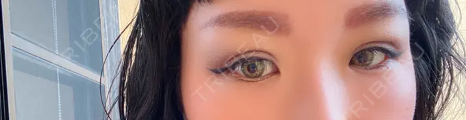 二重埋没 湘南美容クリニック 京都院 DAY 8 メイン用