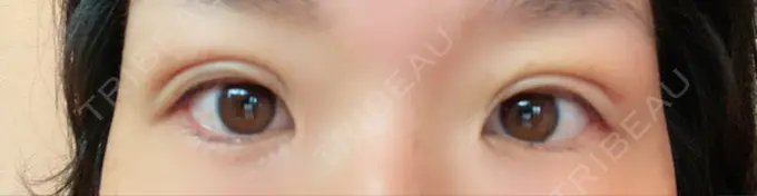 二重埋没 湘南美容クリニック 京都院 DAY 11 メイン用