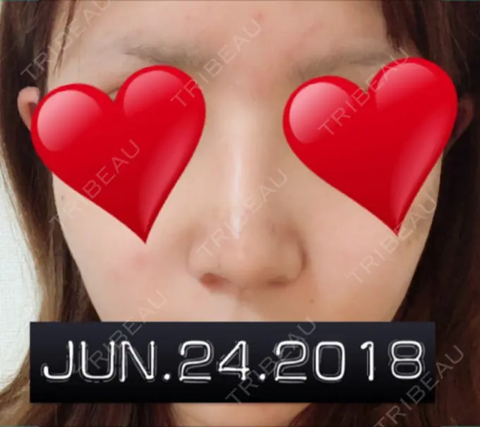 隆鼻術 / 鼻中隔延長（切開） / 軟骨移植 ジュエリー美容外科 DAY 17 メイン用