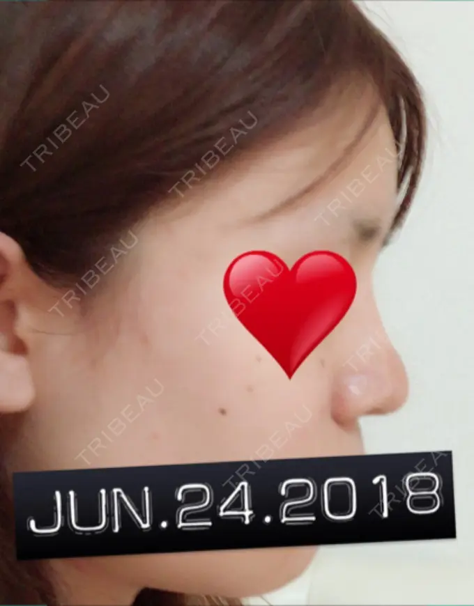 隆鼻術 / 鼻中隔延長（切開） / 軟骨移植 ジュエリー美容外科 DAY 17 メイン用