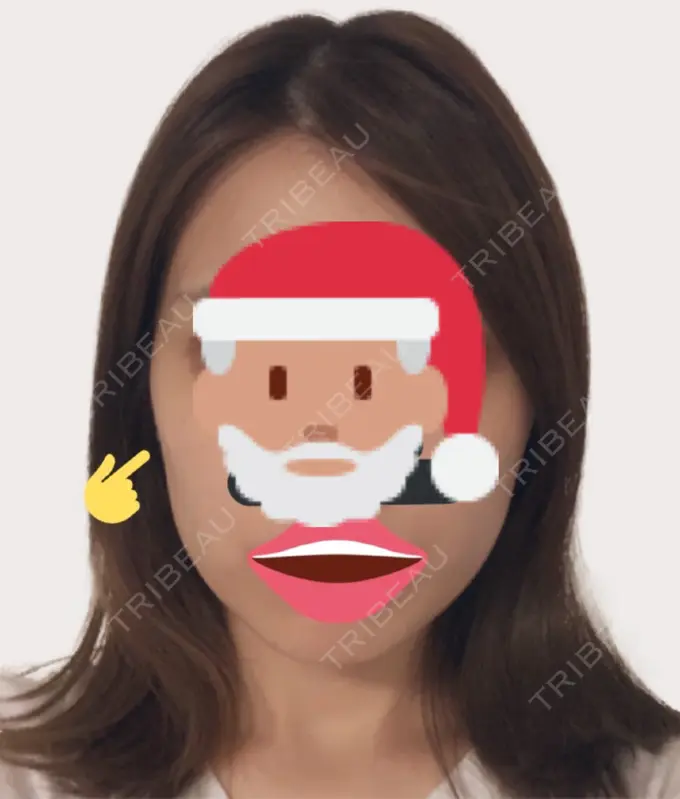 ボトックス（エラ・小顔） 赤坂プレミアクリニック AFTER メイン用