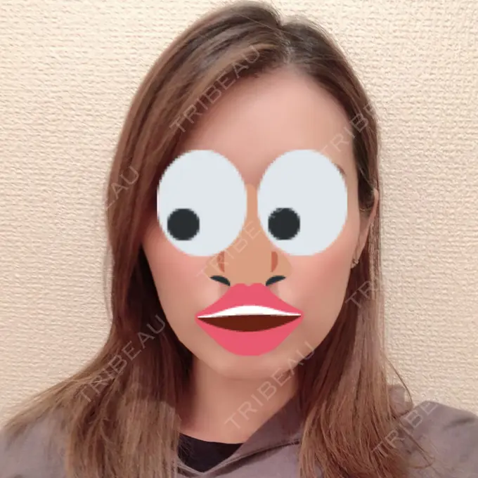 ボトックス（エラ・小顔） 赤坂プレミアクリニック DAY 30 メイン用