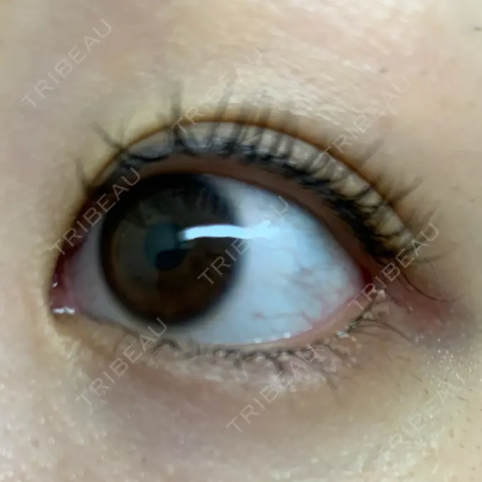 目尻切開 湘南美容クリニック 表参道院 DAY 13 メイン用