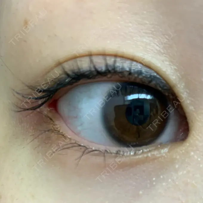 目尻切開 湘南美容クリニック 表参道院 DAY 13 メイン用