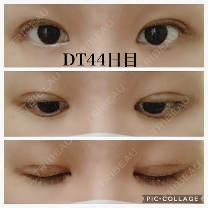 二重切開 水の森美容クリニック 名古屋院 DAY 44 メイン用