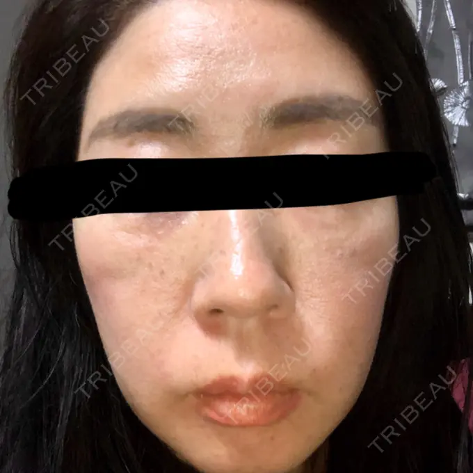 再生医療 RDクリニック大阪 DAY 28 メイン用