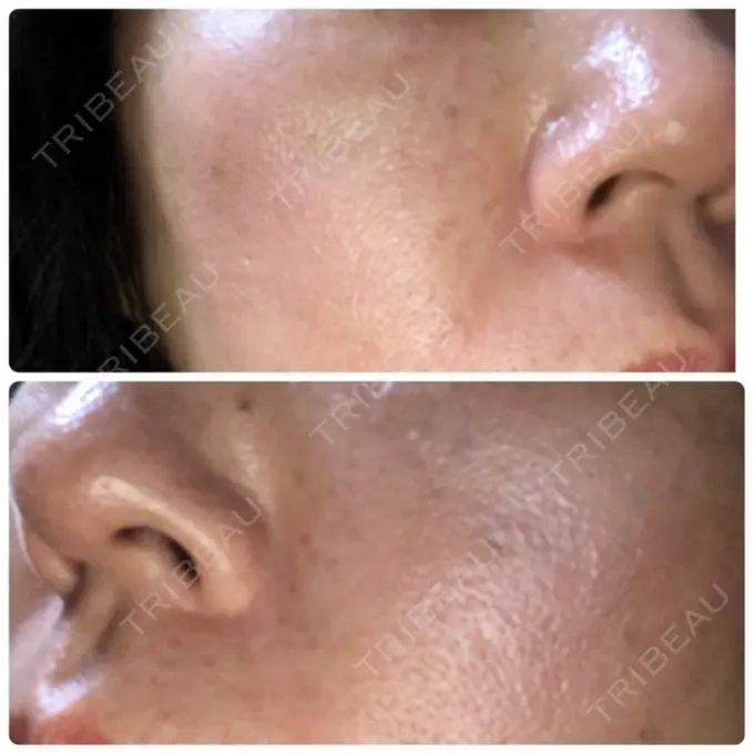 再生医療 RDクリニック大阪 DAY 28 メイン用