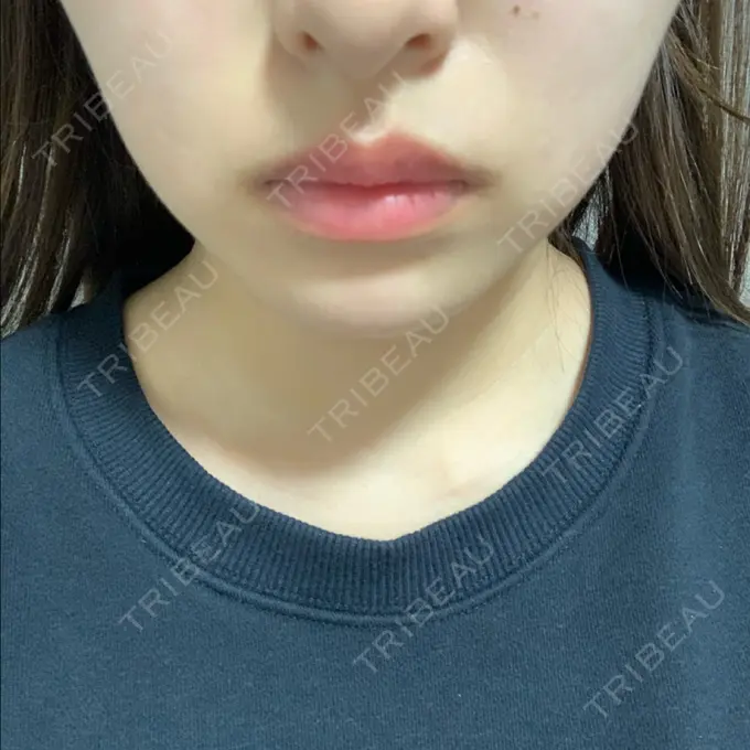 ボトックス（エラ・小顔） TCB東京中央美容外科 堺院 DAY 14 メイン用