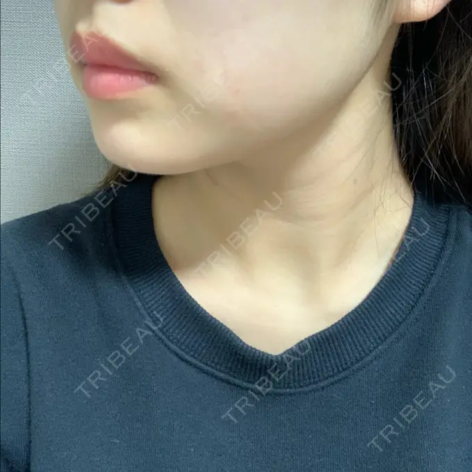 ボトックス（エラ・小顔） TCB東京中央美容外科 堺院 DAY 14 メイン用