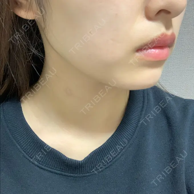 ボトックス（エラ・小顔） TCB東京中央美容外科 堺院 DAY 14 メイン用