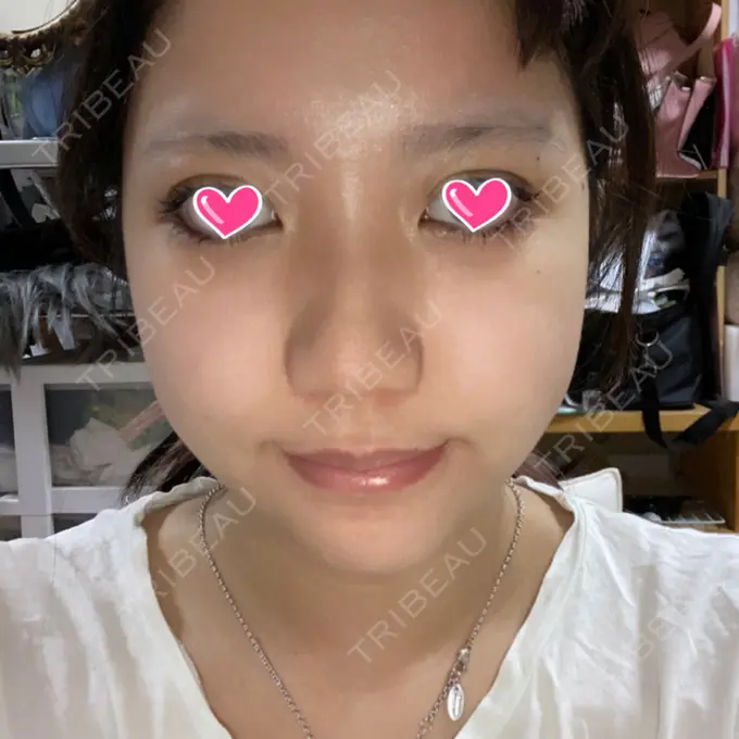 骨切り（あご） / 骨削り（エラ） / 骨削り（頬） View美容整形外科 AFTER メイン用