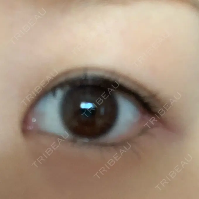 目尻切開 湘南美容クリニック 表参道院 DAY 19 メイン用