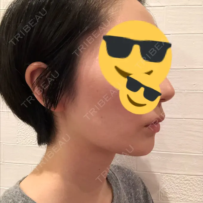 バッカルファット除去 / 脂肪吸引（顔） ジョウクリニック 大阪院 DAY 49 メイン用