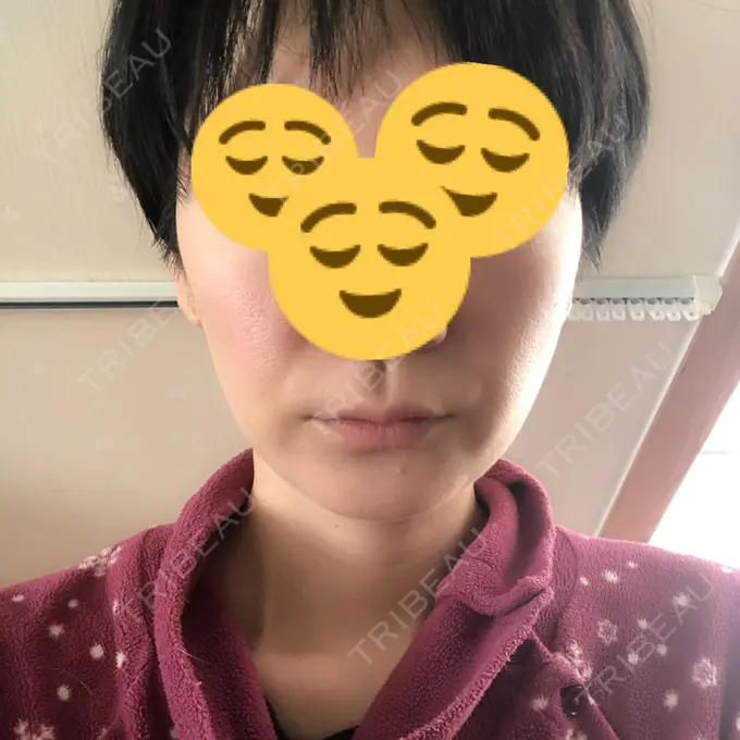 バッカルファット除去 / 脂肪吸引（顔） ジョウクリニック 大阪院 DAY 79 メイン用