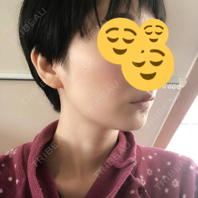 バッカルファット除去 / 脂肪吸引（顔） ジョウクリニック 大阪院 DAY 79 メイン用