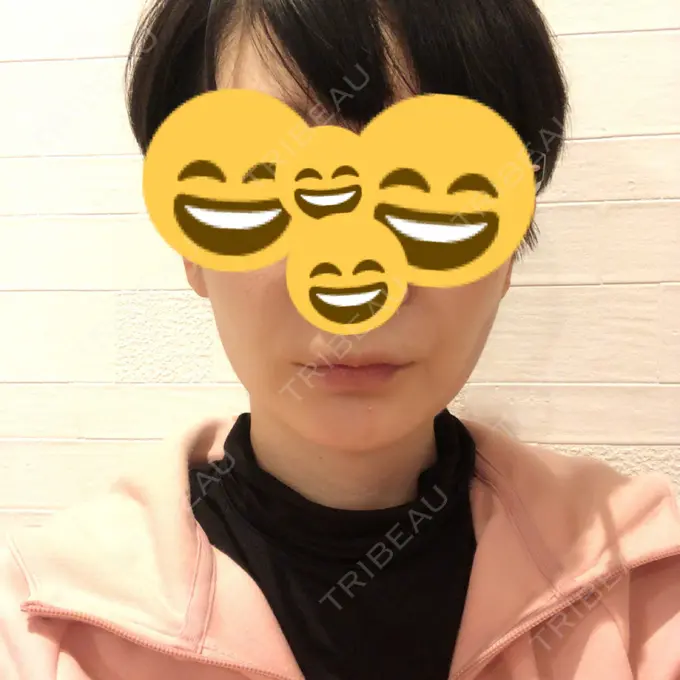 バッカルファット除去 / 脂肪吸引（顔） ジョウクリニック 大阪院 DAY 88 メイン用