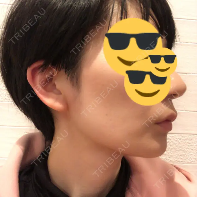 バッカルファット除去 / 脂肪吸引（顔） ジョウクリニック 大阪院 DAY 88 メイン用