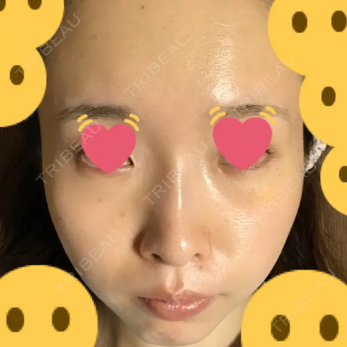 クマ治療 / シミ取りレーザー / その他（目元） 赤坂プレミアクリニック DAY 5 メイン用