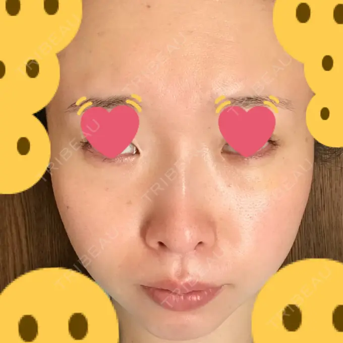 クマ治療 / シミ取りレーザー / その他（目元） 赤坂プレミアクリニック DAY 6 メイン用