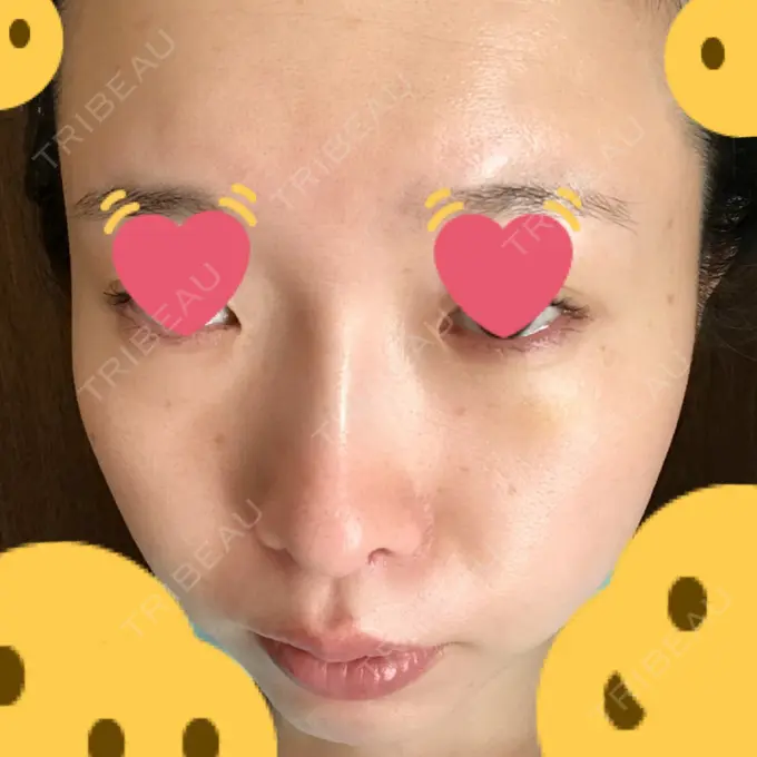 クマ治療 / シミ取りレーザー / その他（目元） 赤坂プレミアクリニック DAY 6 メイン用