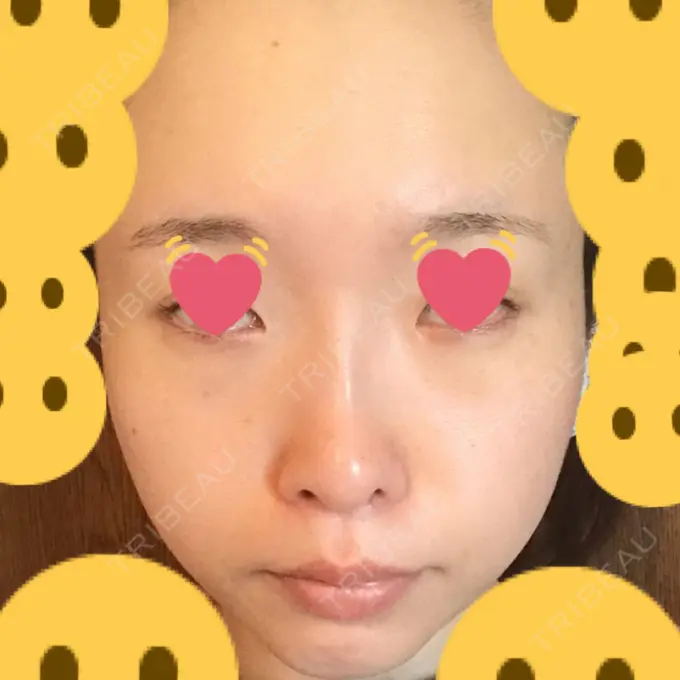 クマ治療 / シミ取りレーザー / その他（目元） 赤坂プレミアクリニック DAY 8 メイン用