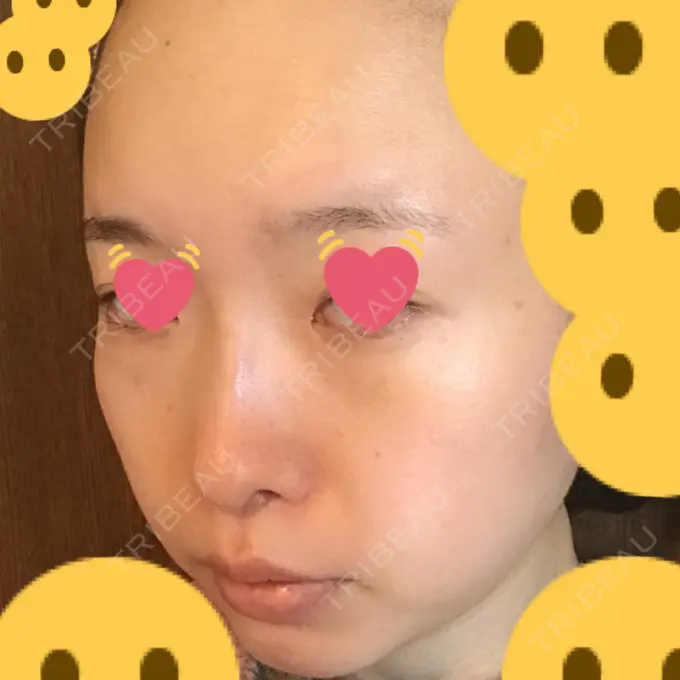 クマ治療 / シミ取りレーザー / その他（目元） 赤坂プレミアクリニック DAY 8 メイン用